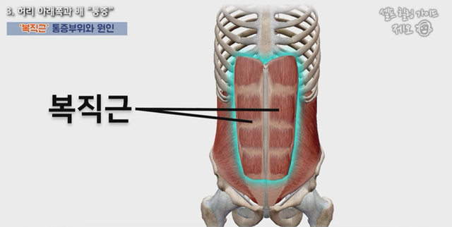 허리통증의 원인이 되는 주요근육 중 복직근(배곧은근). 사진 일지의 브레인TV 갈무리.